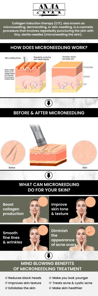 Microneedling, also known as collagen induction therapy, can be highly effective in treating acne scars by stimulating the production of collagen and elastin in the skin. At AgeWell Medicine & Aesthetics, Dr. Frank Dos Santos, DO, MPH, and his team offer microneedling treatments as part of their comprehensive skin care services. With personalized care and advanced techniques, they help clients achieve clearer, smoother skin and improve their overall complexion. For more information, contact us or book an appointment online. We are conveniently located at 2436 Lamington Rd, Suite 1, Bedminster, NJ 07921.