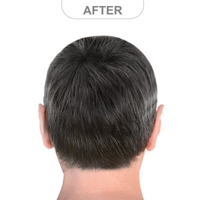 Before and After Results at AgeWell Medicine & Aesthetics in Bedminster, NJ