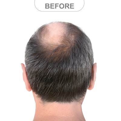 Before and After Results at AgeWell Medicine & Aesthetics in Bedminster, NJ
