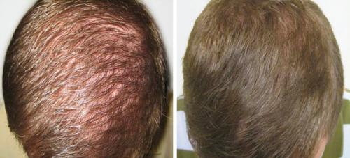Before and After by AgeWell Medicine & Aesthetics in Bedminster, NJ