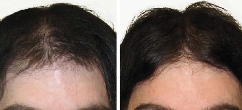 Before and After by AgeWell Medicine & Aesthetics in Bedminster, NJ