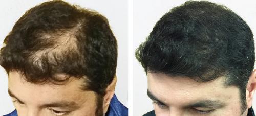 Before and After by AgeWell Medicine & Aesthetics in Bedminster, NJ