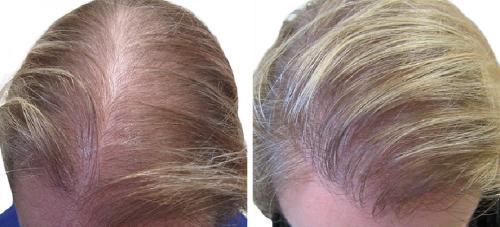 Before and After by AgeWell Medicine & Aesthetics in Bedminster, NJ