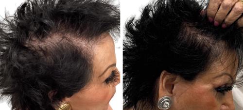 Before and After by AgeWell Medicine & Aesthetics in Bedminster, NJ