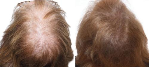 Before and After by AgeWell Medicine & Aesthetics in Bedminster, NJ
