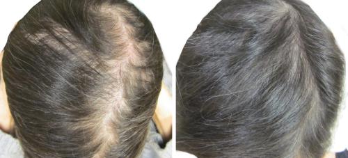 Before and After by AgeWell Medicine & Aesthetics in Bedminster, NJ