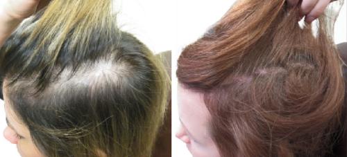 Before and After by AgeWell Medicine & Aesthetics in Bedminster, NJ