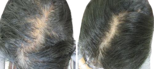 Before and After by AgeWell Medicine & Aesthetics in Bedminster, NJ