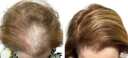 Before and After by AgeWell Medicine & Aesthetics in Bedminster, NJ