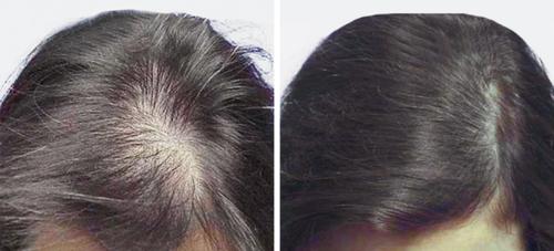 Before and After by AgeWell Medicine & Aesthetics in Bedminster, NJ