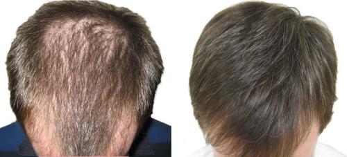 Before and After by AgeWell Medicine & Aesthetics in Bedminster, NJ