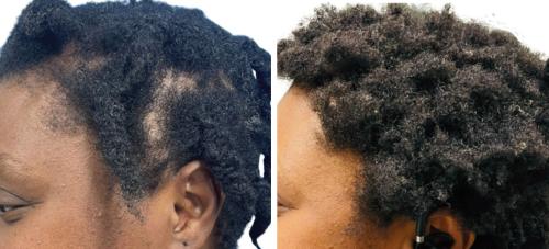 Before and After by AgeWell Medicine & Aesthetics in Bedminster, NJ