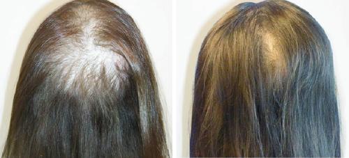Before and After by AgeWell Medicine & Aesthetics in Bedminster, NJ