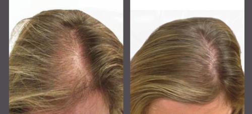Before and After by AgeWell Medicine & Aesthetics in Bedminster, NJ