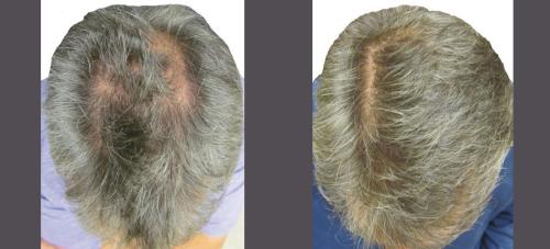 Before and After by AgeWell Medicine & Aesthetics in Bedminster, NJ