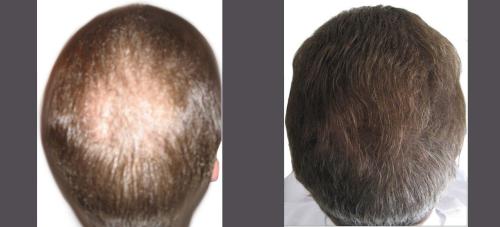 Before and After by AgeWell Medicine & Aesthetics in Bedminster, NJ