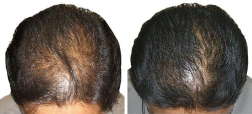 Before and After by AgeWell Medicine & Aesthetics in Bedminster, NJ