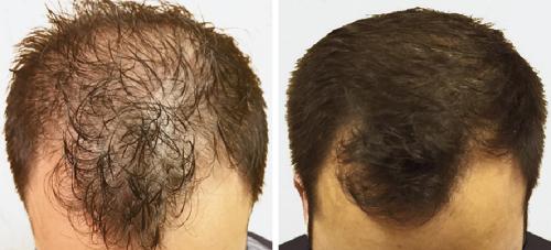 Before and After by AgeWell Medicine & Aesthetics in Bedminster, NJ