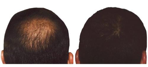 Before and After by AgeWell Medicine & Aesthetics in Bedminster, NJ