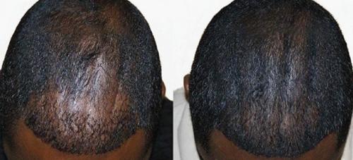 Before and After by AgeWell Medicine & Aesthetics in Bedminster, NJ