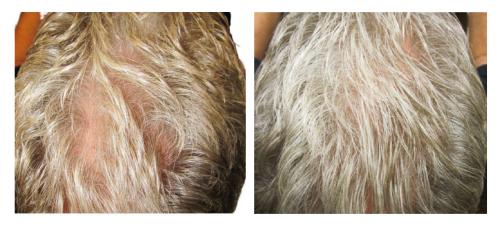 Before and After by AgeWell Medicine & Aesthetics in Bedminster, NJ